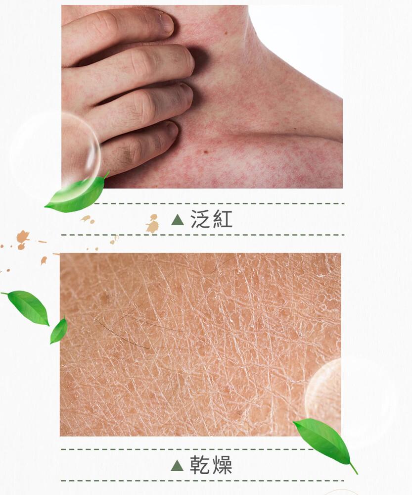 ▲泛紅，▲乾燥。