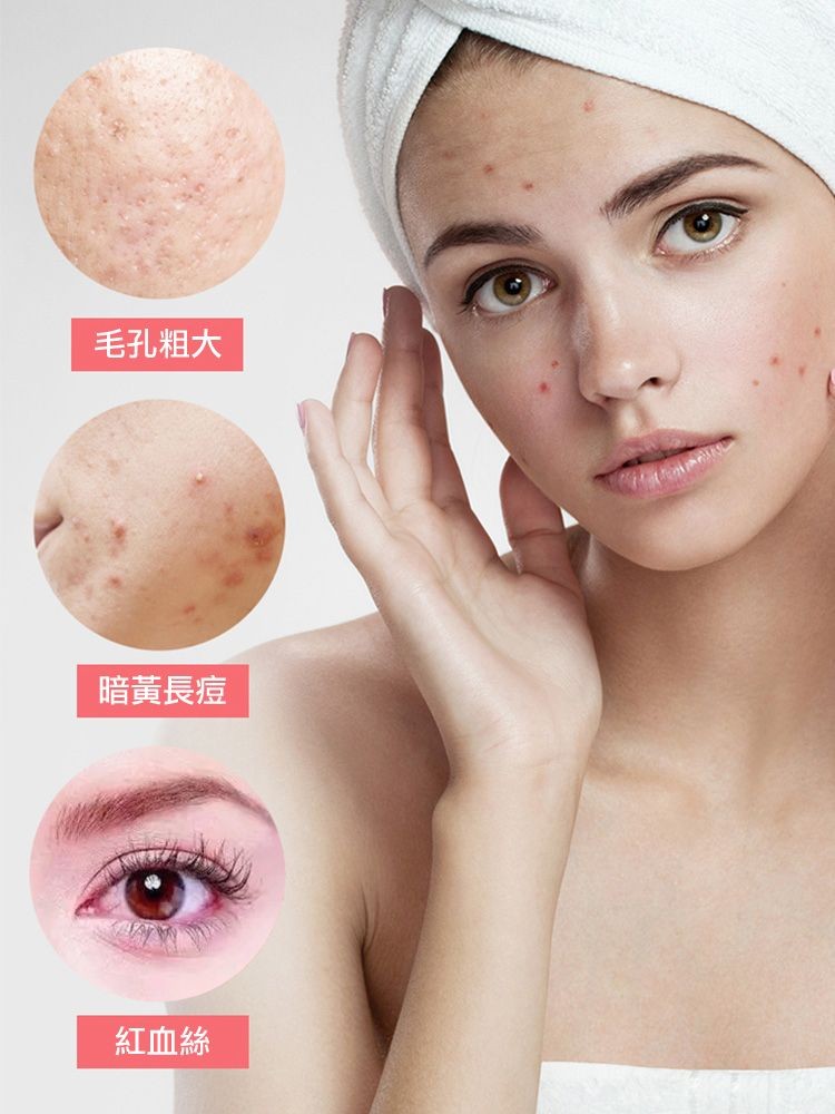 毛孔粗大，暗黃長痘，紅血絲。