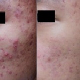 ★二代碳粉+淨膚★【淨痘型柔膚雷射】不限發數碳粉雷射+淨膚雷射+淨痘毛孔護理 ◆先打先淨痘◆搶先試打價（月底截止）