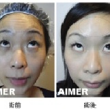 肉毒桿菌【抬頭紋】2700元 揪團方案