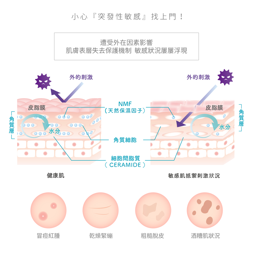 角質層L,小心突發性敏感找上門!遭受外在因素影響,肌膚表層失去保護機制 敏感狀況屢屢浮現,皮脂膜,外的刺激,外的刺激,皮脂膜,(天然保濕因子),水分。0,角質細胞,細胞間脂質,健康肌,敏感肌抵禦刺激狀況,1角質層┐,冒痘紅腫,乾燥緊繃,粗糙脫皮,酒糟
