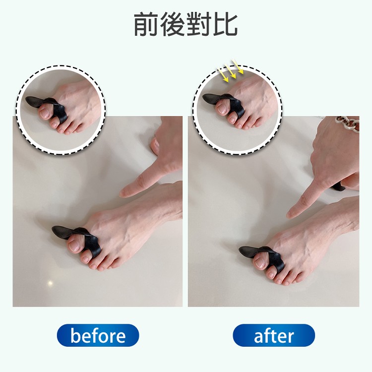 最新代黑科技【拇指外翻神器】獨家添加銀離子竹炭粉